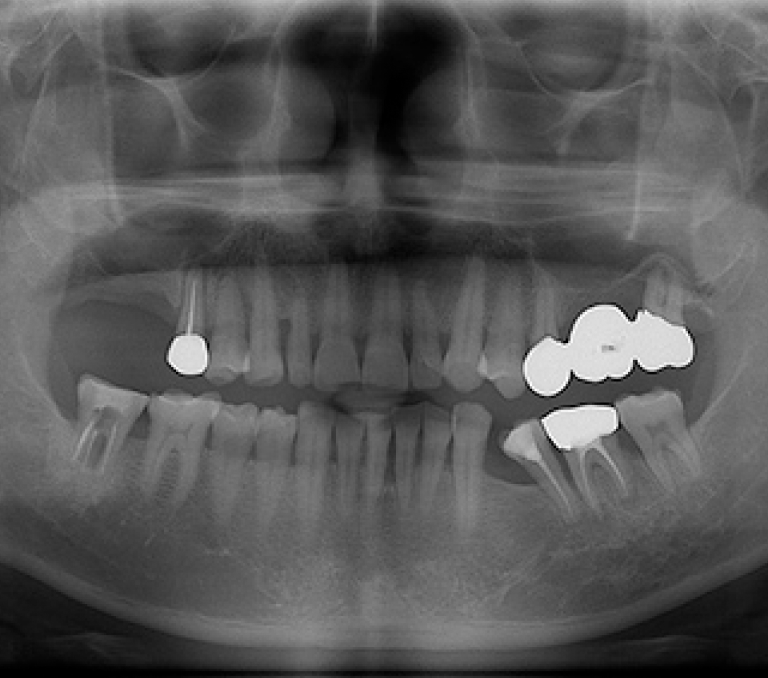 실제 부모님 임플란트 수술 전후 X-ray BEFORE