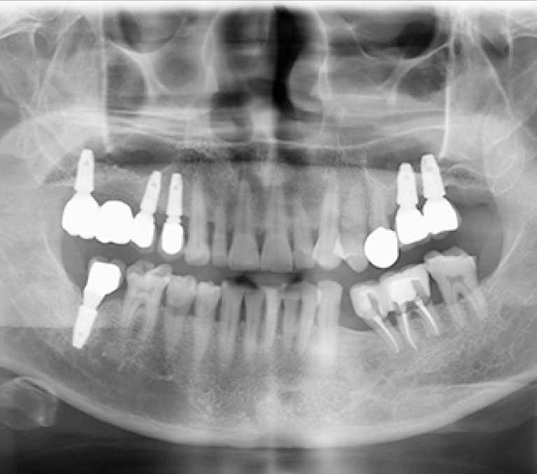 실제 부모님 임플란트 수술 전후 X-ray AFTER