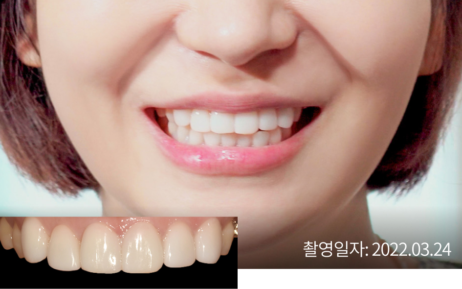 라미네이트 시술 after