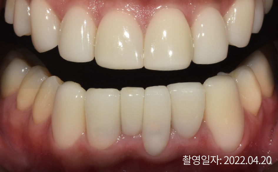 라미네이트 시술 after