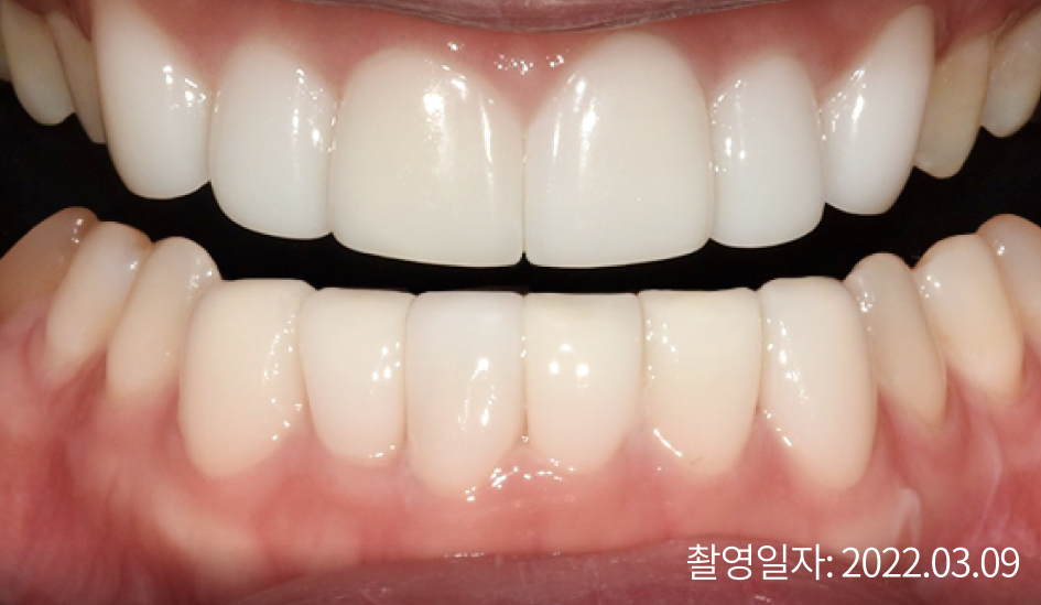 라미네이트 시술 after